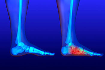 Flat Feet Treatment in the Queens County, NY: Flushing (College Point, Linden Hill, Malba, Whitestone, Jackson Heights, Corona) and Elmhurst, NY (Forest Hills, Kew Garden Hills, Utopia, Murray Hills, Auburndale, Fresh Meadows, Sunnyside, Maspeth, Woodside) areas