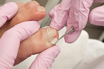 Ingrown toenail in the Queens County, NY: Flushing (College Point, Linden Hill, Malba, Whitestone, Jackson Heights, Corona) and Elmhurst, NY (Forest Hills, Kew Garden Hills, Utopia, Murray Hills, Auburndale, Fresh Meadows, Sunnyside, Maspeth, Woodside) areas