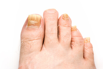 Fungal toenails treatment in the Queens County, NY: Flushing (College Point, Linden Hill, Malba, Whitestone, Jackson Heights, Corona) and Elmhurst, NY (Forest Hills, Kew Garden Hills, Utopia, Murray Hills, Auburndale, Fresh Meadows, Sunnyside, Maspeth, Woodside) areas