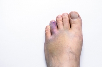 Various Ways to Break Your Toe