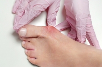 Common Causes of Foot Deformities