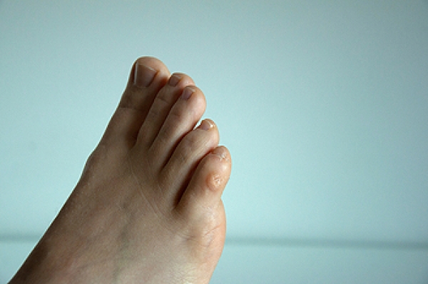 Facts About Corns on the Feet