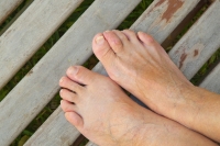 Hammertoe and Orthotics